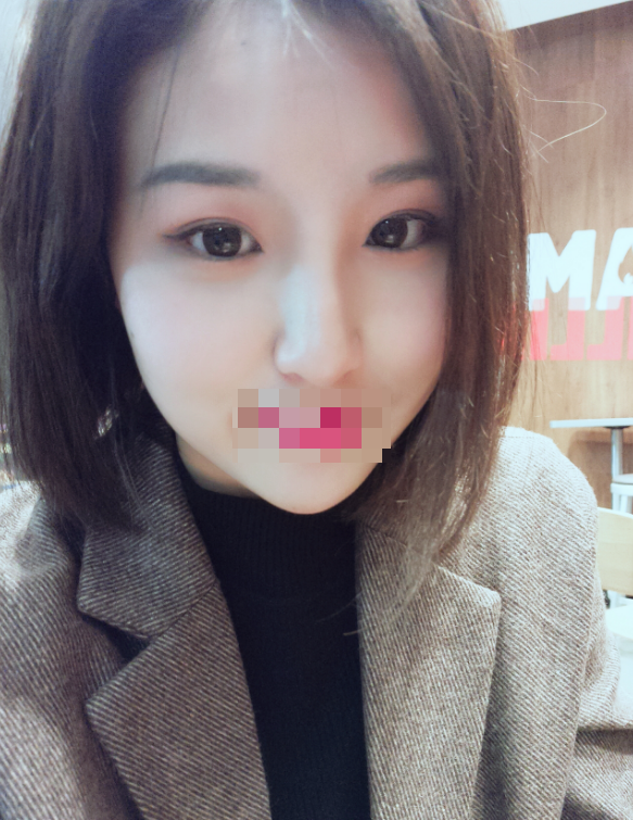 长沙*双眼皮恢复后76天