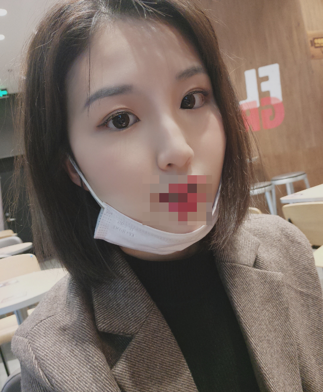 长沙*双眼皮恢复后76天