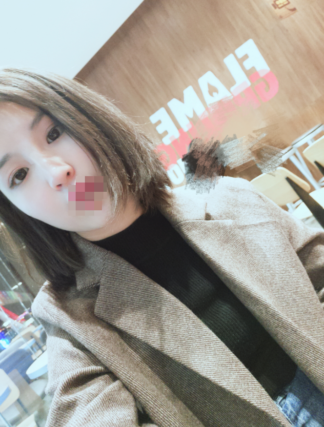 长沙*双眼皮恢复后76天