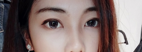 切开双眼皮术后第207天 于晓波割双眼皮怎么样 *果好吗