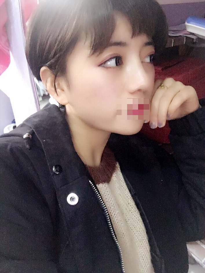 综合隆鼻 术后一个月　　长沙真爱黄志鹏隆鼻怎么样