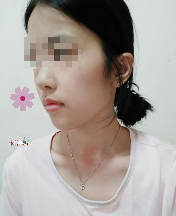 颧骨颧弓整形术后69天了 祝亲爱的宝宝们在新的一年平安.健康. 幸福.快乐!