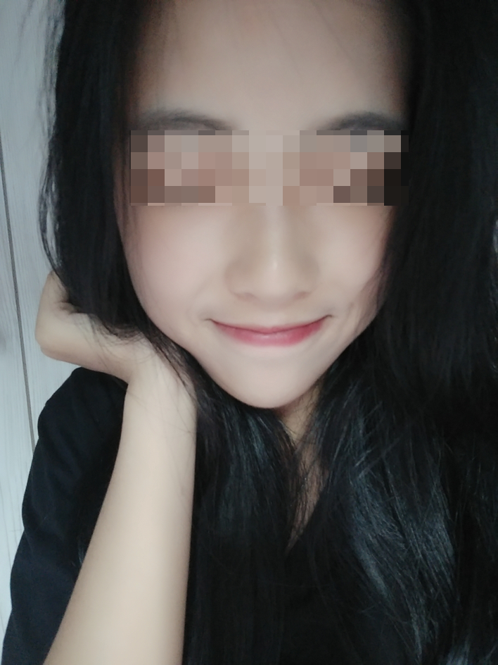 颧骨颧弓整形术后69天了 祝亲爱的宝宝们在新的一年平安.健康. 幸福.快乐!