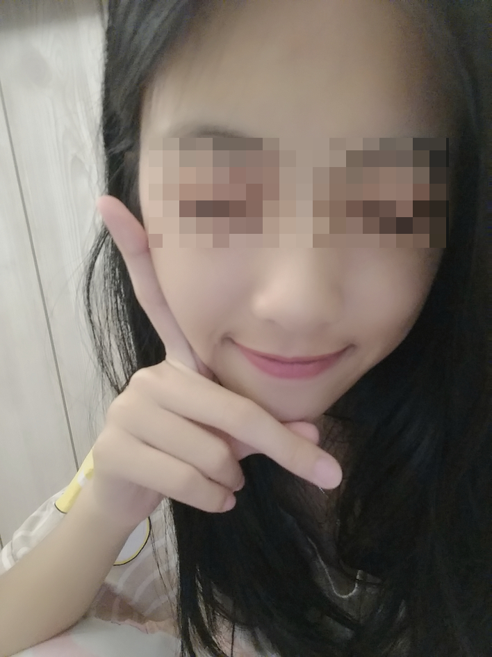 颧骨颧弓整形术后69天了 祝亲爱的宝宝们在新的一年平安.健康. 幸福.快乐!
