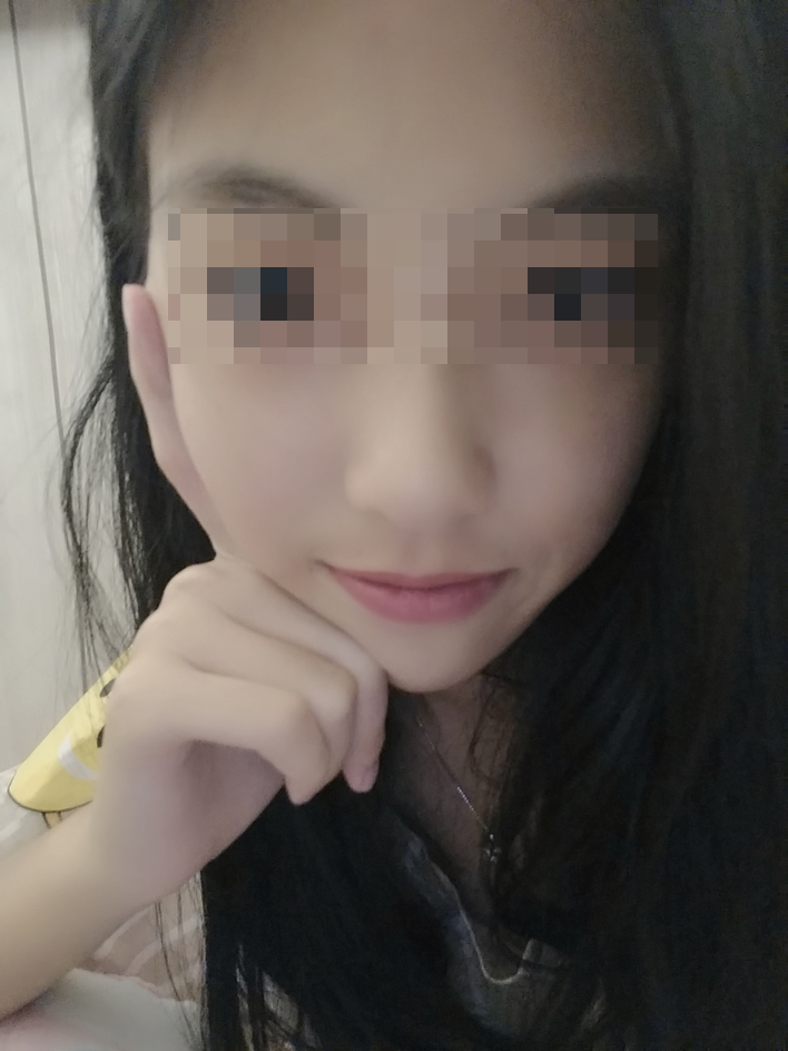 颧骨颧弓整形术后69天了 祝亲爱的宝宝们在新的一年平安.健康. 幸福.快乐!