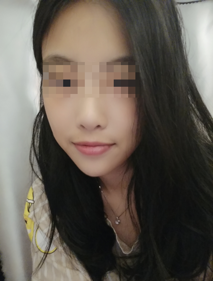 颧骨颧弓整形术后69天了 祝亲爱的宝宝们在新的一年平安.健康. 幸福.快乐!