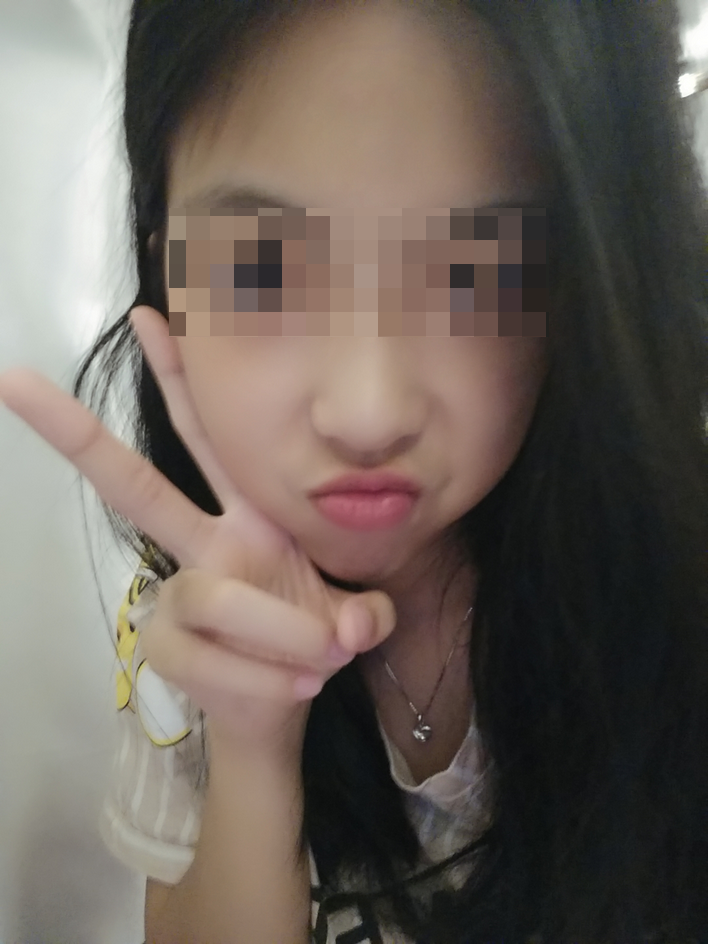 颧骨颧弓整形术后69天了 祝亲爱的宝宝们在新的一年平安.健康. 幸福.快乐!