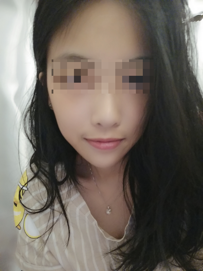 颧骨颧弓整形术后69天了 祝亲爱的宝宝们在新的一年平安.健康. 幸福.快乐!