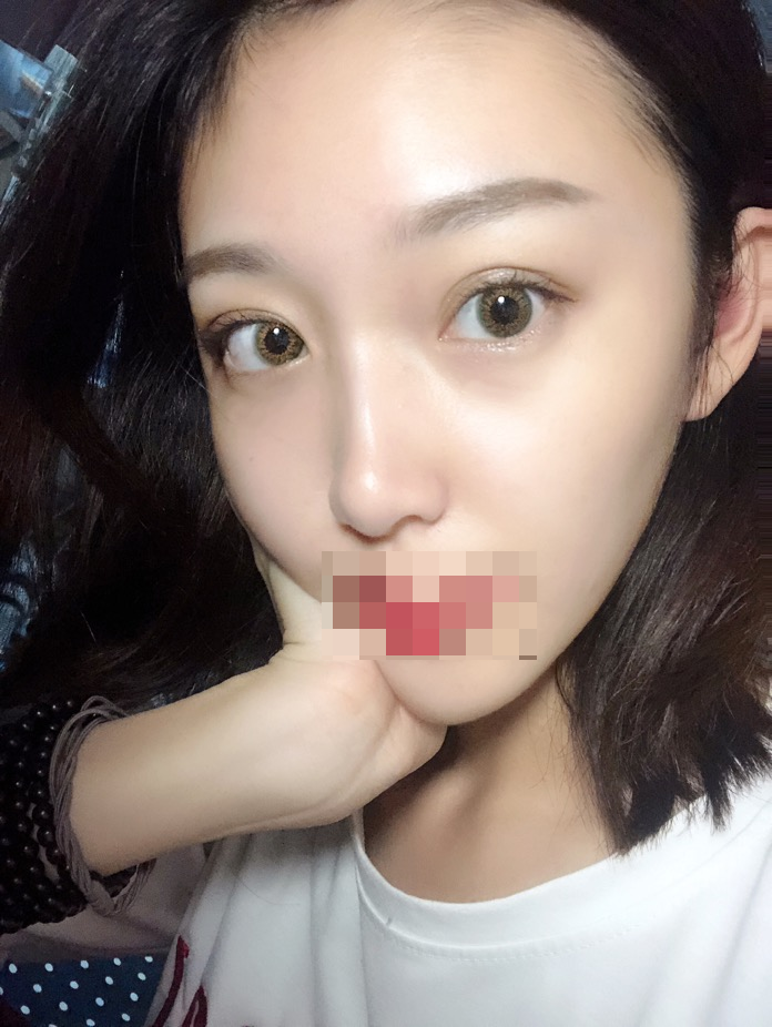 综合隆鼻三个月了。时间过得好快~武汉华美整形医院隆鼻怎么样?案例图有吗