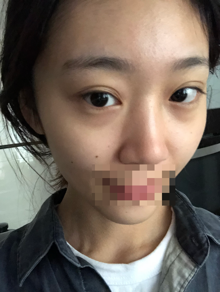 综合隆鼻三个月了。时间过得好快~武汉华美整形医院隆鼻怎么样?案例图有吗
