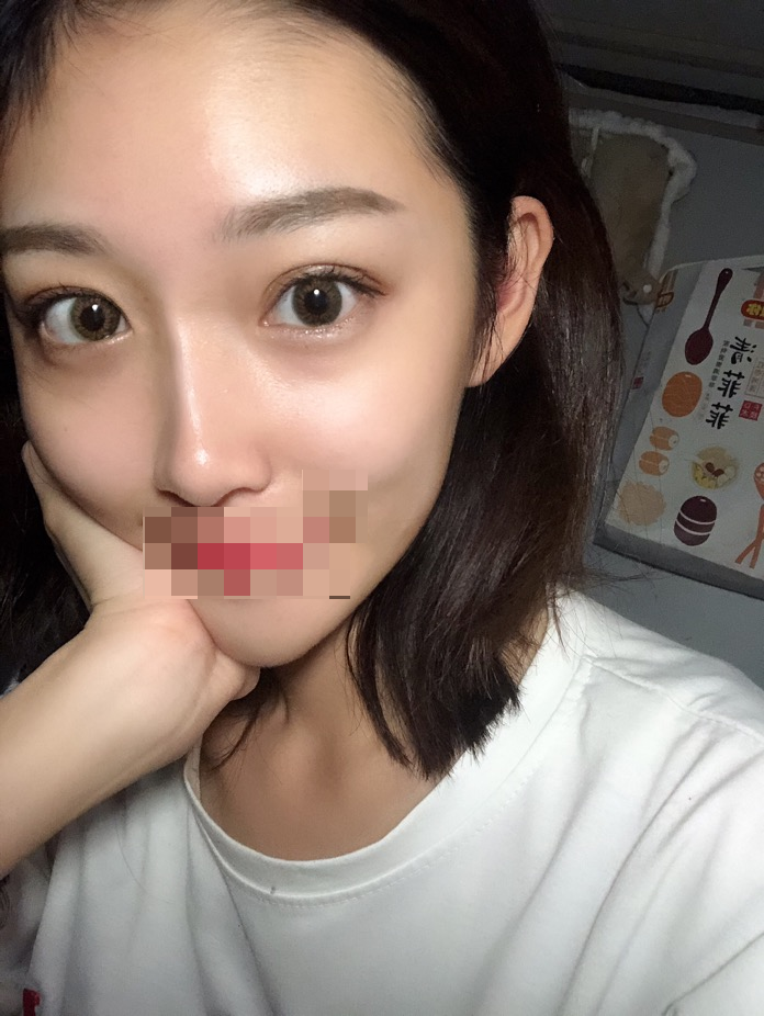 综合隆鼻三个月了。时间过得好快~武汉华美整形医院隆鼻怎么样?案例图有吗