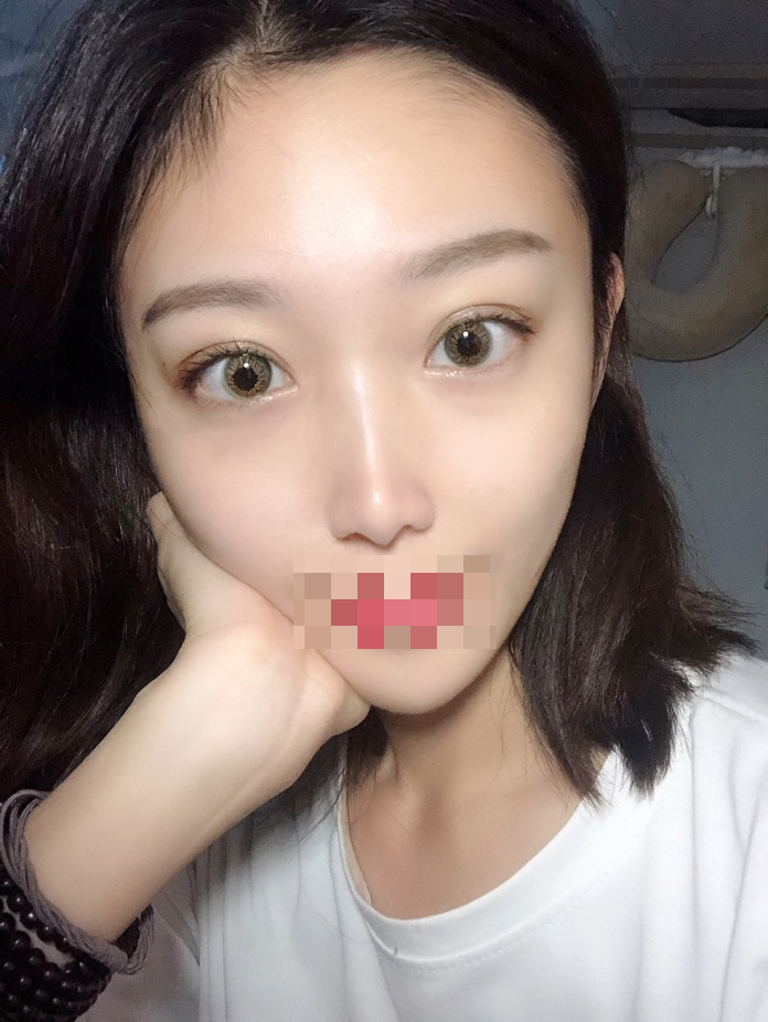 综合隆鼻三个月了。时间过得好快~武汉华美整形医院隆鼻怎么样?案例图有吗