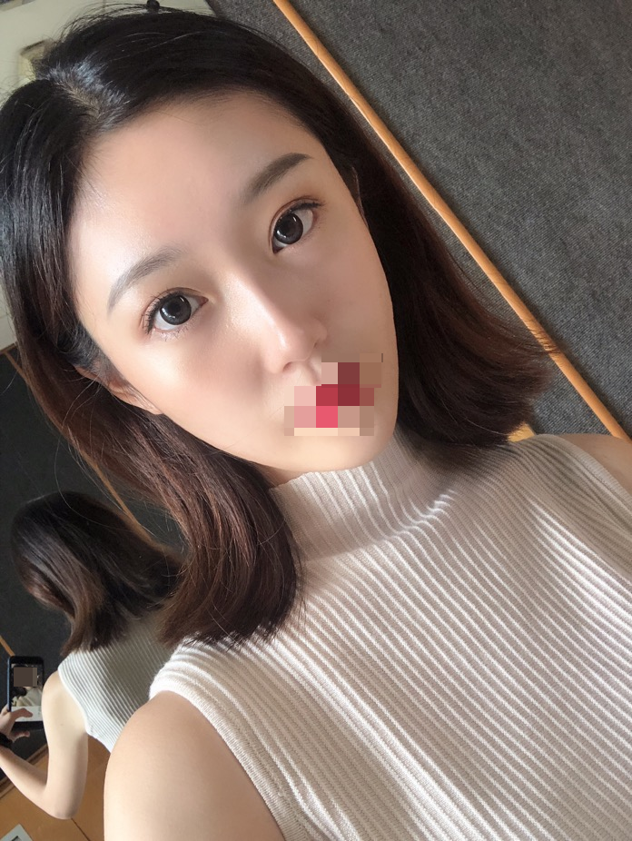 综合隆鼻三个月了。时间过得好快~武汉华美整形医院隆鼻怎么样?案例图有吗