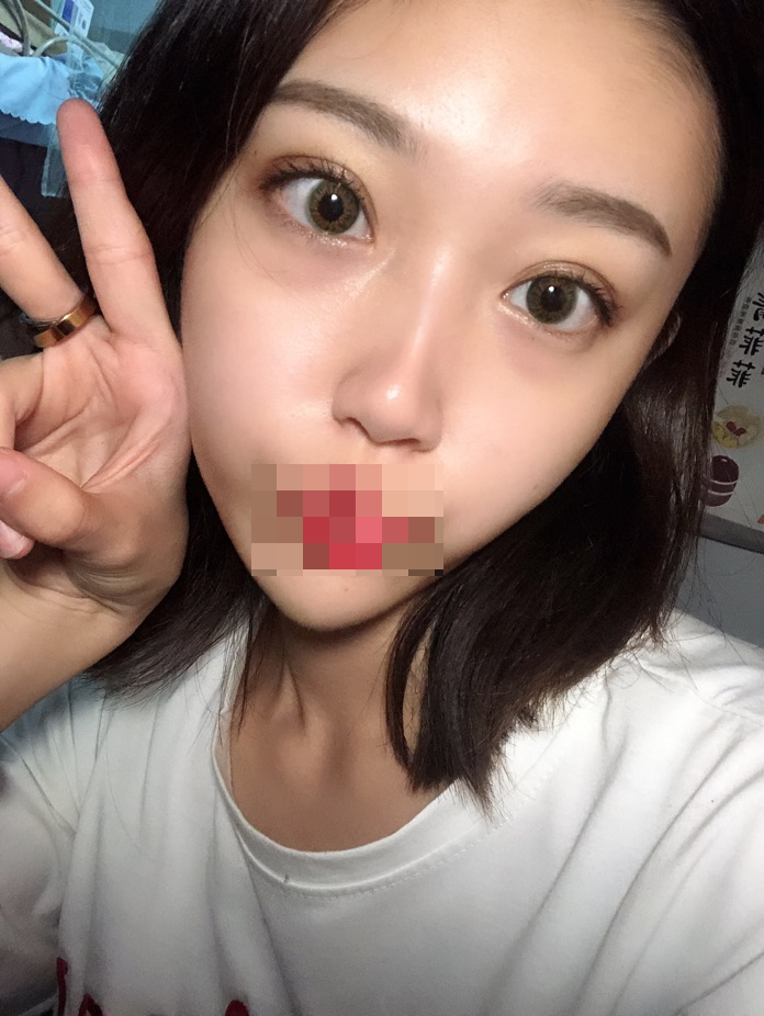 综合隆鼻三个月了。时间过得好快~武汉华美整形医院隆鼻怎么样?案例图有吗
