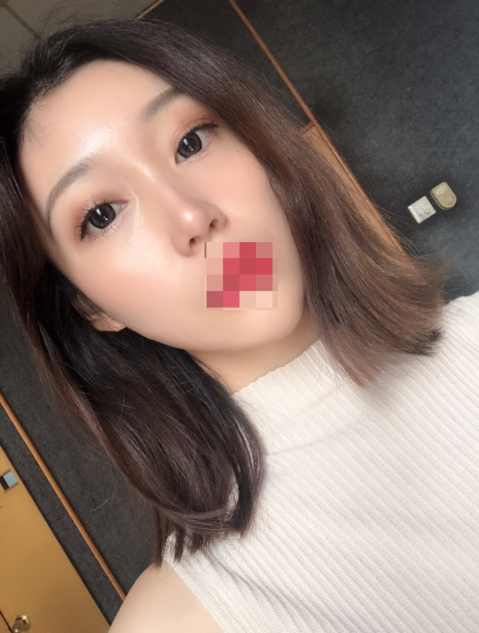 综合隆鼻三个月了。时间过得好快~武汉华美整形医院隆鼻怎么样?案例图有吗