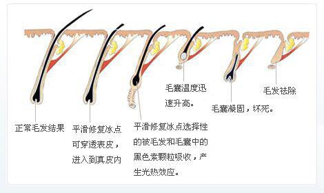 关于“脱毛”你该知道的那些事~注意事项