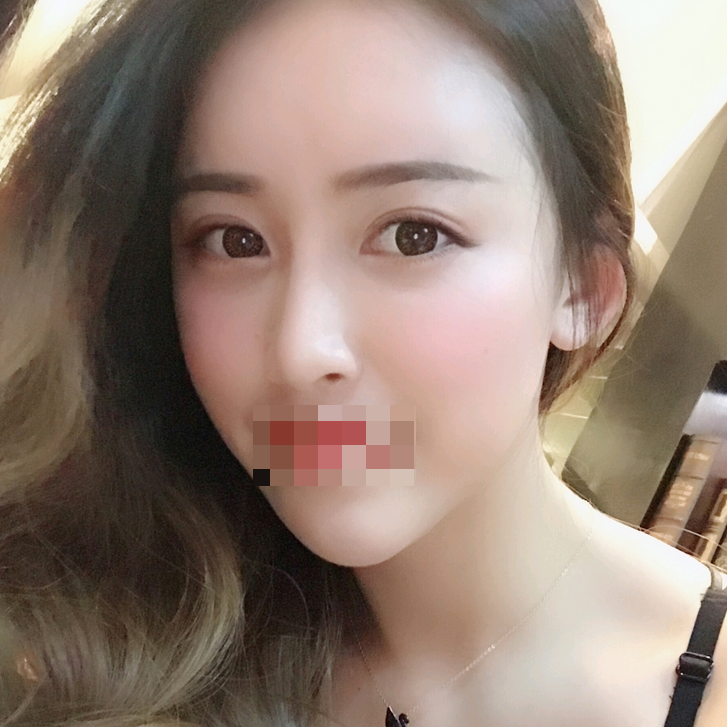重庆双眼皮恢复的越来越自然了，虽说现在肉眼看不到其中的恢复