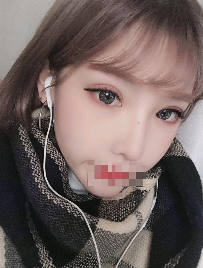 综合隆鼻转眼都过去好几个月了…过得真快啊。重庆精美整形田永华隆鼻案例图怎么样?好看吗