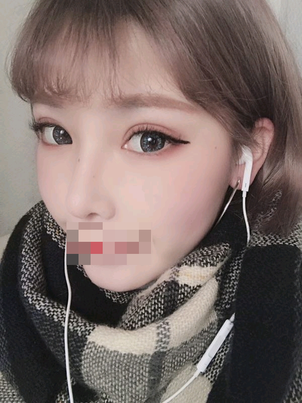 综合隆鼻转眼都过去好几个月了…过得真快啊。重庆精美整形田永华隆鼻案例图怎么样?好看吗