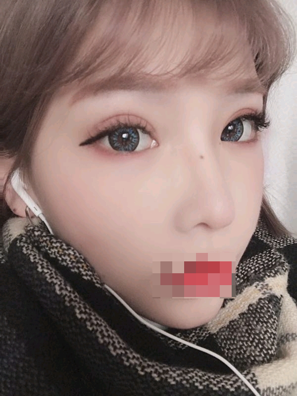综合隆鼻转眼都过去好几个月了…过得真快啊。重庆精美整形田永华隆鼻案例图怎么样?好看吗