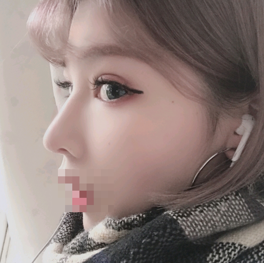 综合隆鼻转眼都过去好几个月了…过得真快啊。重庆精美整形田永华隆鼻案例图怎么样?好看吗