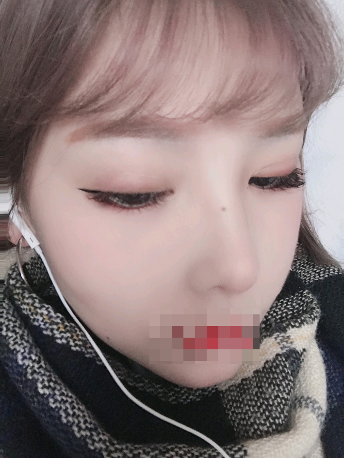 综合隆鼻转眼都过去好几个月了…过得真快啊。重庆精美整形田永华隆鼻案例图怎么样?好看吗