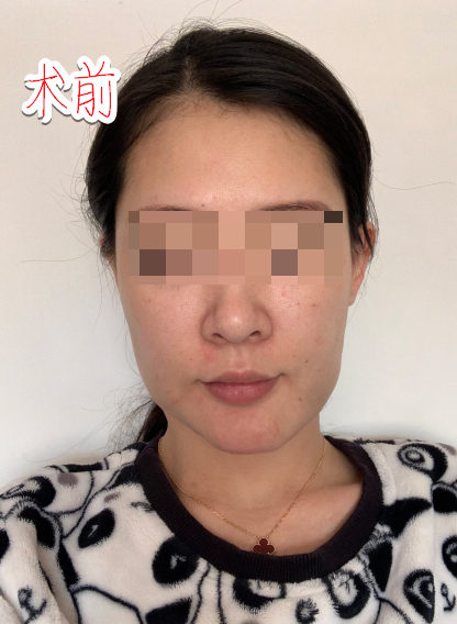 下颌角削骨磨骨术后三天 重庆时光整形磨骨怎么样?案例图
