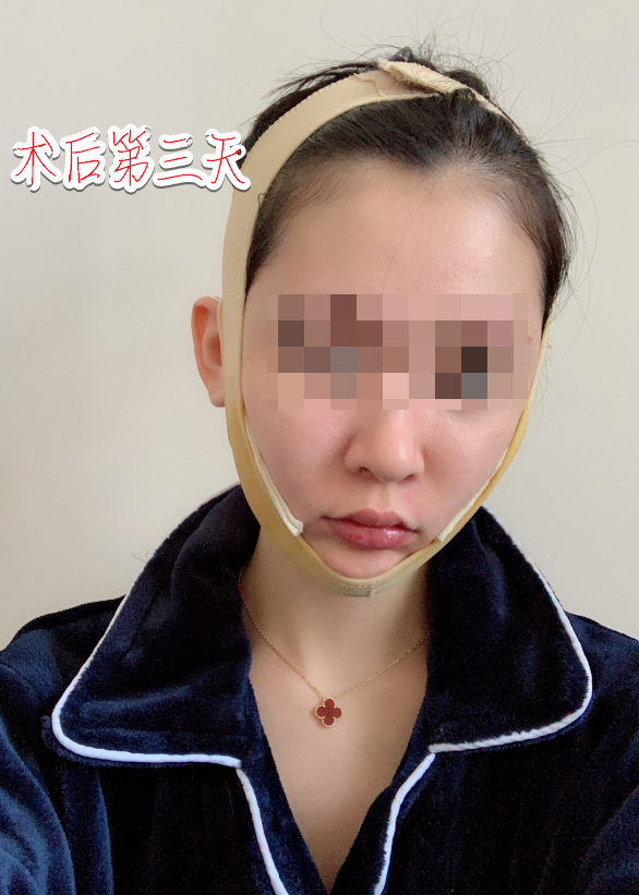 下颌角削骨磨骨术后三天 重庆时光整形磨骨怎么样?案例图