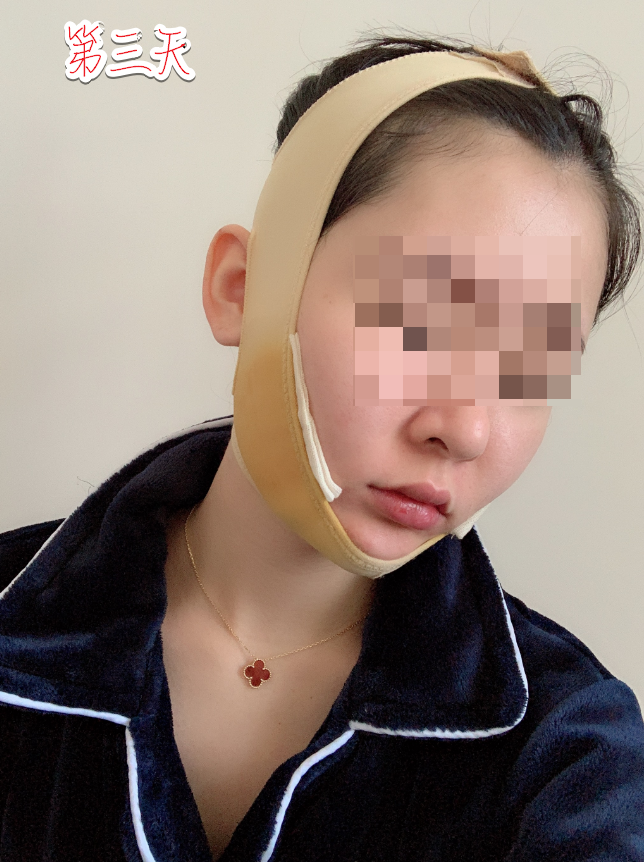 下颌角削骨磨骨术后三天 重庆时光整形磨骨怎么样?案例图