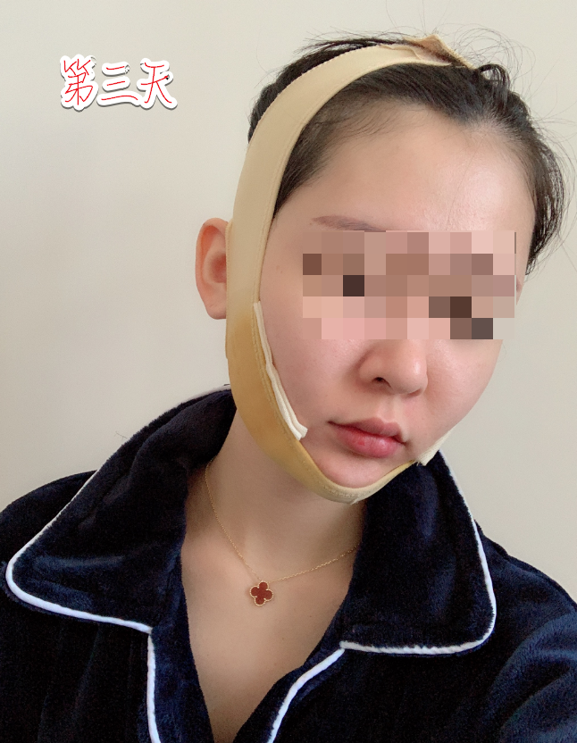 下颌角削骨磨骨术后三天 重庆时光整形磨骨怎么样?案例图