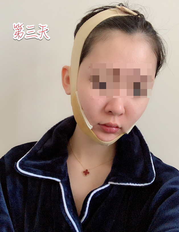 下颌角削骨磨骨术后三天 重庆时光整形磨骨怎么样?案例图