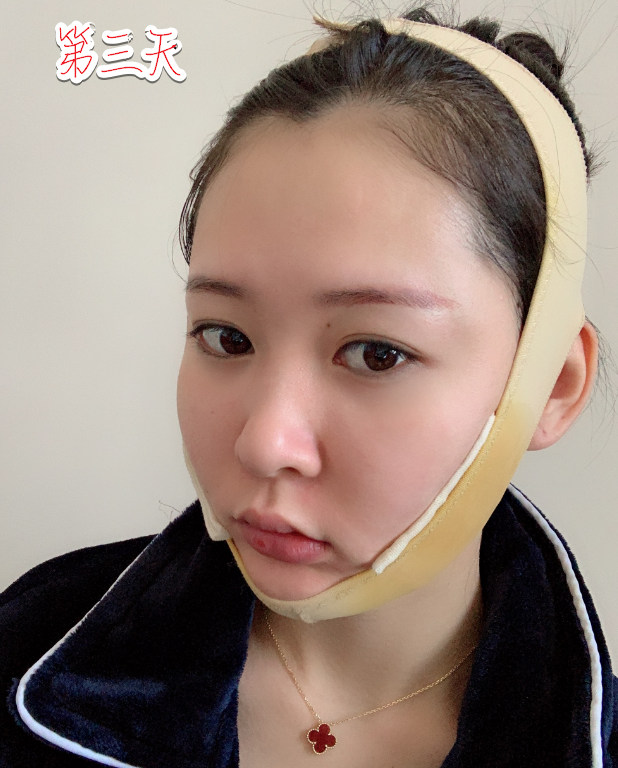 下颌角削骨磨骨术后三天 重庆时光整形磨骨怎么样?案例图