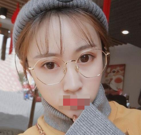 全切双眼皮术前到术后三个月详细记录 东莞知美割双眼皮案例怎么样?