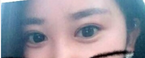 清华大学玉泉医院吕晓杰医生全切双眼皮,价格7000