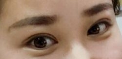 清华大学玉泉医院吕晓杰医生全切双眼皮,价格7000
