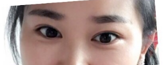 清华大学玉泉医院吕晓杰医生全切双眼皮,价格7000