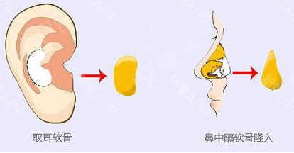 软骨隆鼻包括耳软骨、鼻中隔软骨、肋软骨，那么该怎么选择它们了？