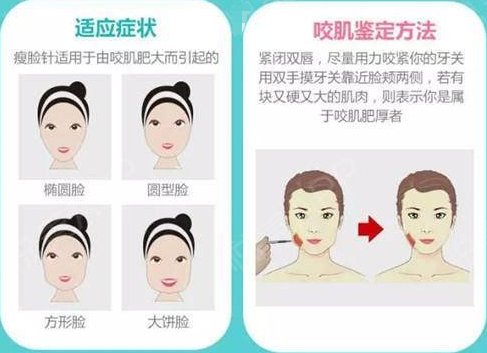 如何判断自己脸肥胖是否是咬肌作祟呢?**