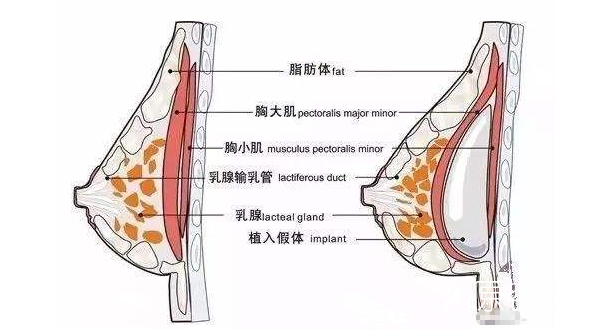 胸部整形手术会不会影响哺乳呢？