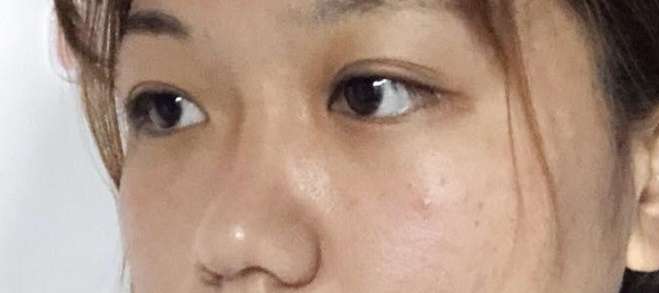 合肥隆鼻术后一个星期啦~超好开心的!