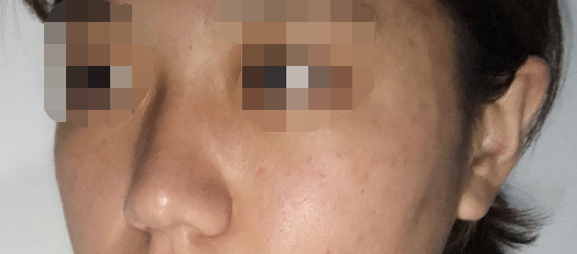 合肥隆鼻术后一个星期啦~超好开心的!