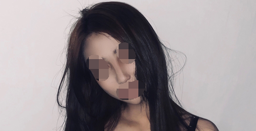 现在做完都要一年了了,*开始没想到会这么好看 南昌佳美张*恩隆鼻案例图