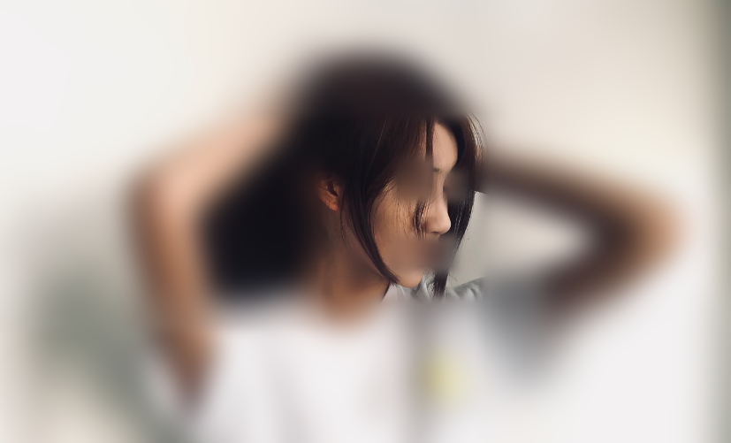 现在做完都要一年了了,*开始没想到会这么好看 南昌佳美张*恩隆鼻案例图
