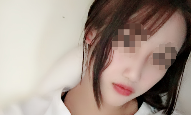 现在做完都要一年了了,*开始没想到会这么好看 南昌佳美张*恩隆鼻案例图