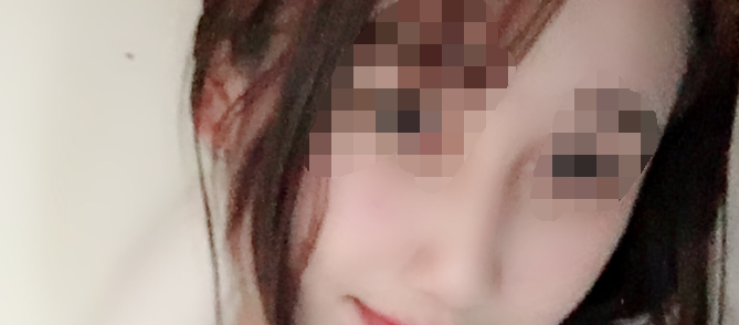 现在做完都要一年了了,*开始没想到会这么好看 南昌佳美张*恩隆鼻案例图