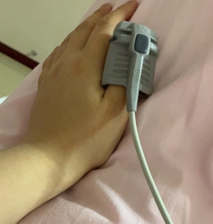 我做的全身吸脂，但是因为一次不可以吸太多，所以先吸了大腿 吸脂案例图分享
