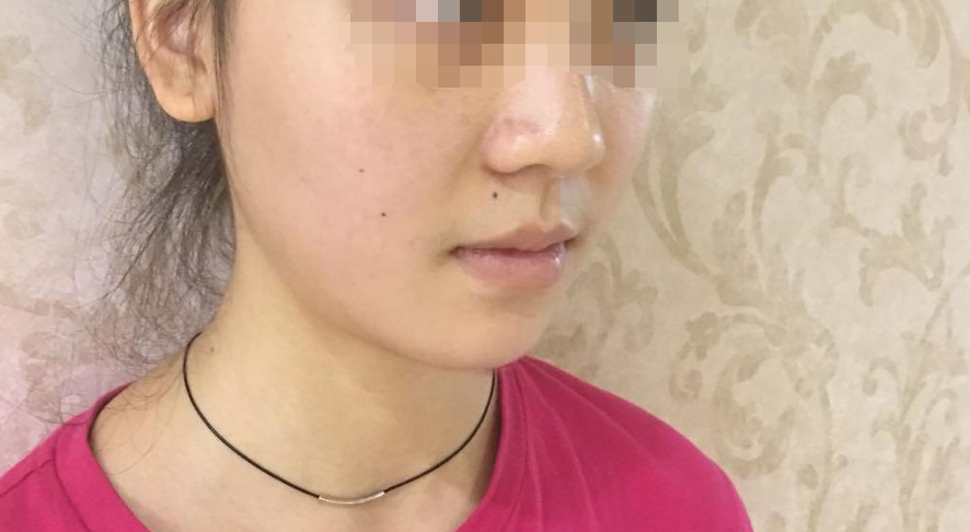 下巴的弧度还是很不错的,大家看照片看的出来,成都华西李正勇垫下巴隆鼻案例图怎么样