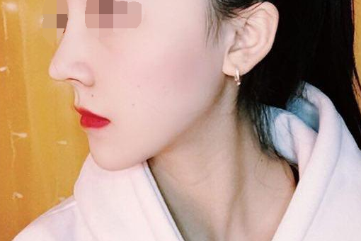 下巴的弧度还是很不错的,大家看照片看的出来,成都华西李正勇垫下巴隆鼻案例图怎么样