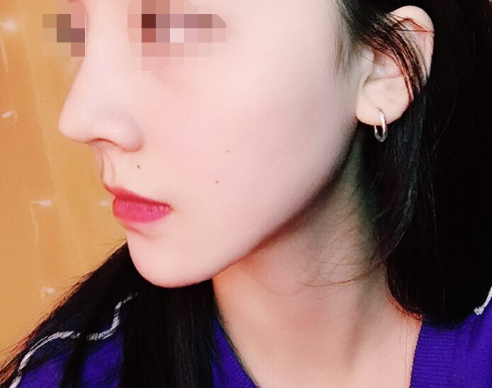 下巴的弧度还是很不错的,大家看照片看的出来,成都华西李正勇垫下巴隆鼻案例图怎么样