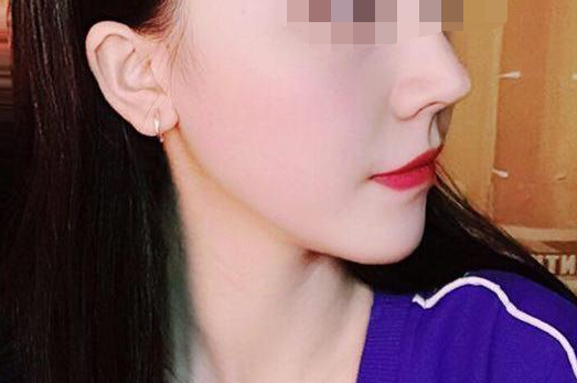 下巴的弧度还是很不错的,大家看照片看的出来,成都华西李正勇垫下巴隆鼻案例图怎么样